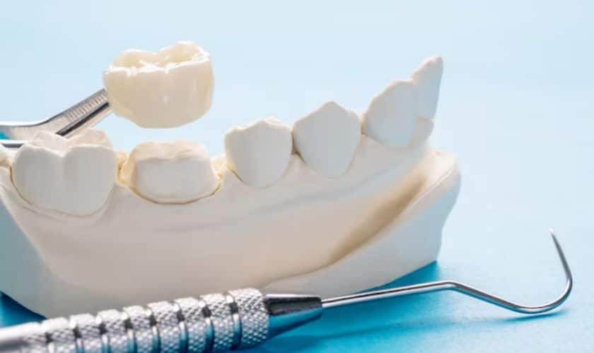 How Dental Crowns Can Transform Your Smile A Comprehensive Guide